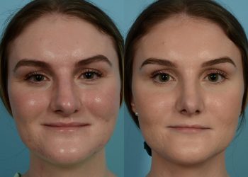 Rhinoplasty Surgery Clinic In Illinois