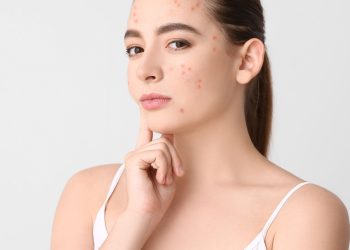 Skin Boosters for Acne-Prone Skin 